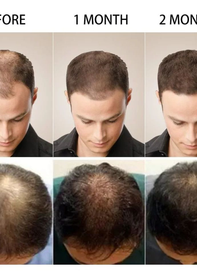 Эссенция имбиря для быстрого роста волос Pure Hair Growth Essence Oil 20мл PURC (266624349)