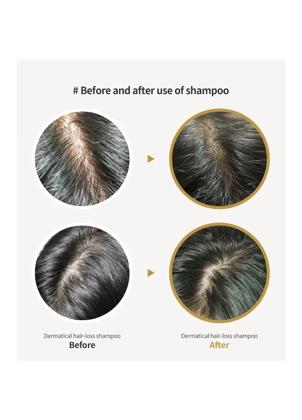 Шампунь DERMATICAL HAIR-LOSS SHAMPOO против выпадения для тонких волос, 200 мл LADOR (260196055)