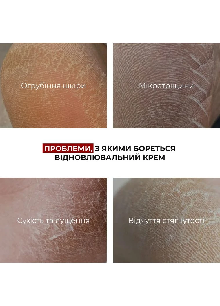 Комплекс для загоєння тріщин та пом’якшення п’ят Cracked Heel Repair & Softening Complex Hillary (387363390)