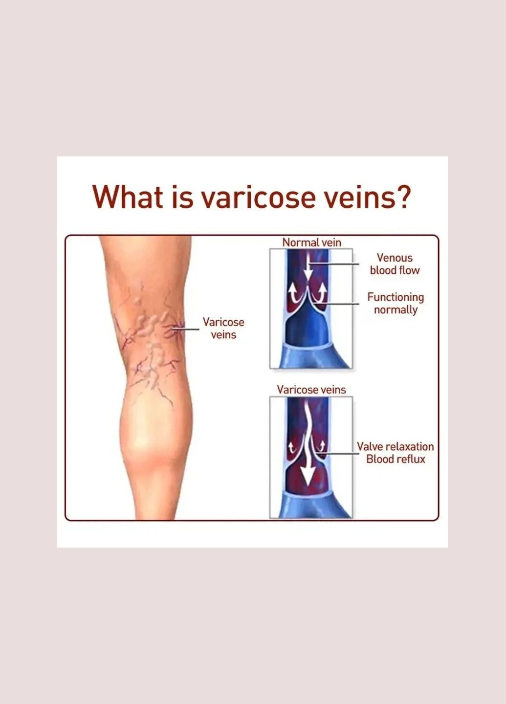 Пластир від варикозного розширення вен та зірочок на ногах з турмаліном, судинної дисфункції 6 шт No Brand (335039980)