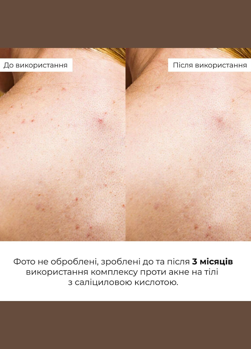 Набор против акне на теле с салициловой кислотой Triple-Action Hillary (352166436)