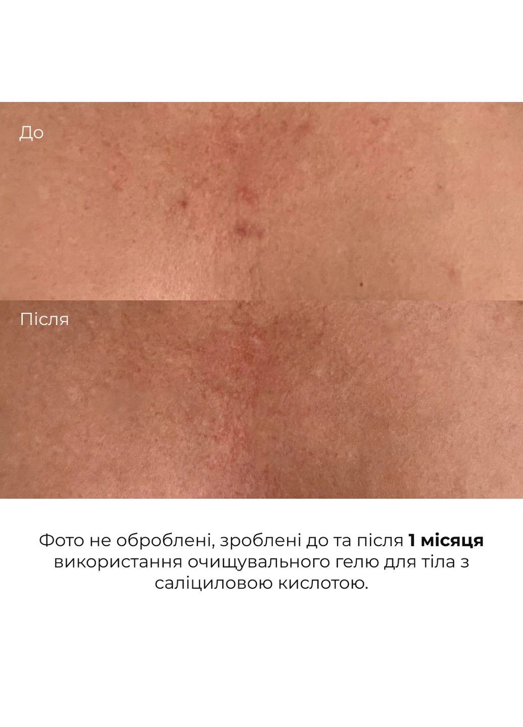 Очищающий гель для тела с салициловой кислотой Anti-Acne Salicylic Body Wash 200 мл Hillary (333828457)