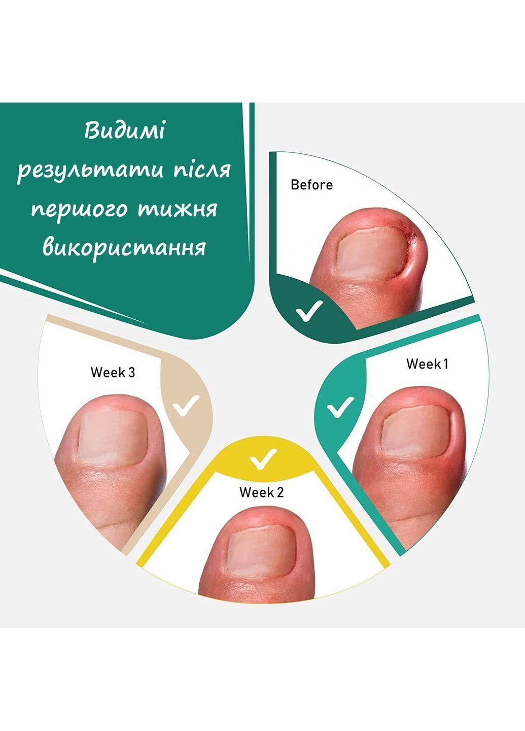 Набор пластин для исправления и коррекции вросшего ногтя набор 10 шт в банке No Brand (364506679)