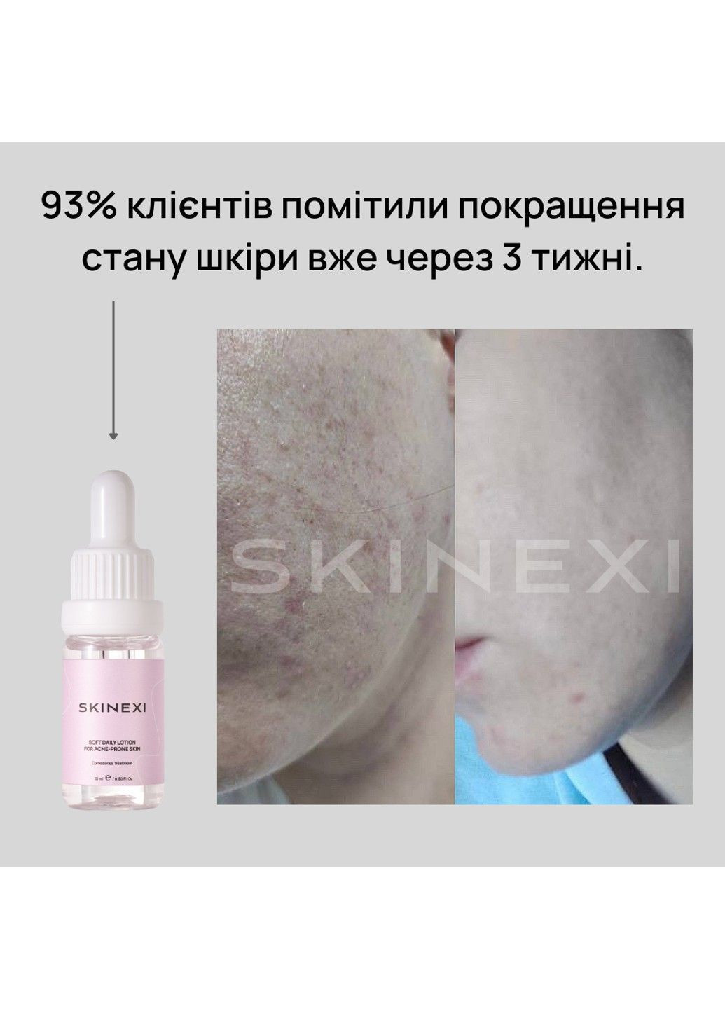 Лосьон для проблемной кожи от комедонов и чёрных точек Soft Daily Lotion Skinexi (365284453)