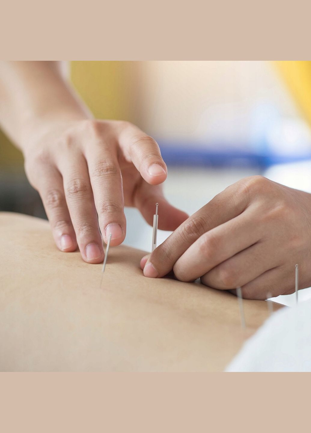 Иглы акупунктурные 0.3 х 75 мм с направляющей 100 шт 4FJ0552 4FIZJO (340108357)