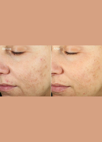 Відновлююча сироватка від шрамів та плям після прищів InvisiScar Resurfacing Treatment 15 мл Murad (298578561)