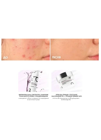 SOS-НАБІР ПРОТИ АКНЕ З НІАЦИНАМІДОМ RoBeauty (379737143)