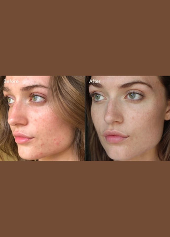 Відновлююча сироватка від шрамів та плям після прищів InvisiScar Resurfacing Treatment 15 мл Murad (298578561)