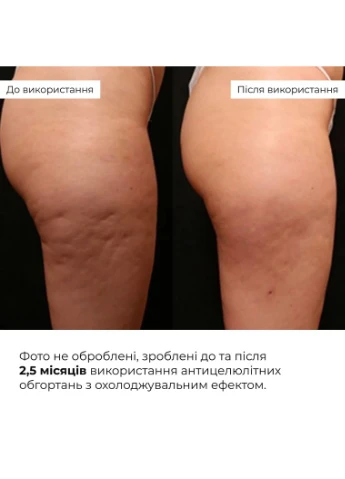 Охлаждающие антицеллюлитные обертывания 10 уп. для тела с лифтинг-эффектом для уменьшения целлюлита. Hillary (387361319)