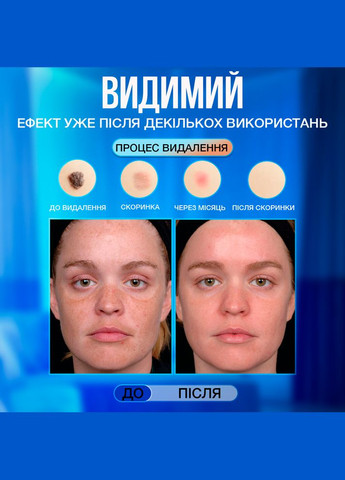 Электрокоагулятор плазменный прибор для удаления папиллом бородавок VLVEE профессиональный аппарат (VLV-5163) No Brand (342418085)