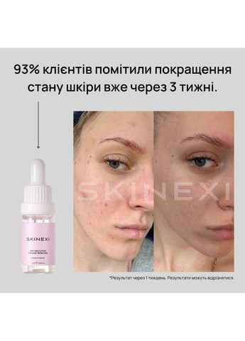 Лосьон для проблемной кожи от комедонов и чёрных точек Soft Daily Lotion Skinexi (365284453)