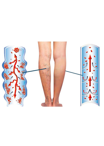 Крем от варикозного расширения вен и сосудистых звездочек для кровообращения, баночка 20 г, 1 шт No Brand (372474873)