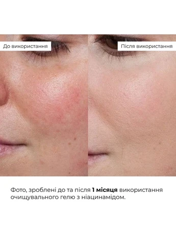 Комплекс для очищения и борьбы с высыпаниями с ниацинамидом набор для проблемной кожи с акне и угревыми высыпаниями. Hillary (387361432)