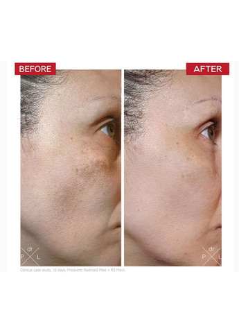 Пілінг Dr. Levy Radical3 Reboot Pro Peel (50ml) Radical (367832484)