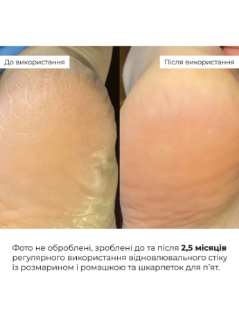 Комплекс для загоєння тріщин, живлення та захисту стоп Cracked Heel Healing, Nourishment & Protection Hillary (387369318)