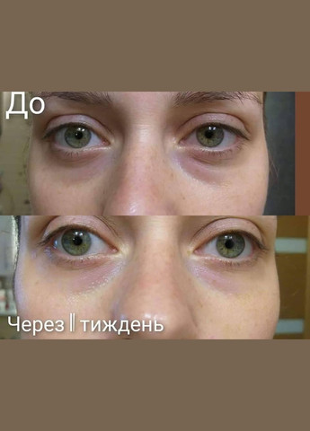 Патчі для зменшення темних кіл та набряків під очима J'erelia (315818367)