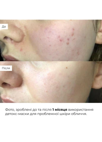 Глиняна маска для обличчя Anti-Acne детокс для проблемної шкіри очищення акне 90 мл (652933) Hillary (383428544)