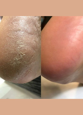 Кератолитик для ног Podology+ с мочевиной 20%, 100 мл Nails of the day (329900553)