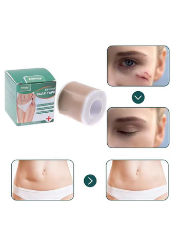 Медицинский силиконовый пластырь для заживления рубцов после операции, при ожогах и растяжках 4×150 см No Brand (337169225)