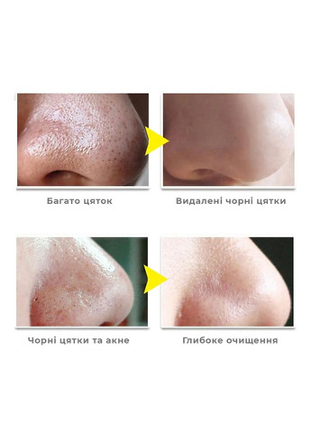 Маска від вугрів і чорних крапок для обличчя 30г+60 смужок LANBENA (329442814)