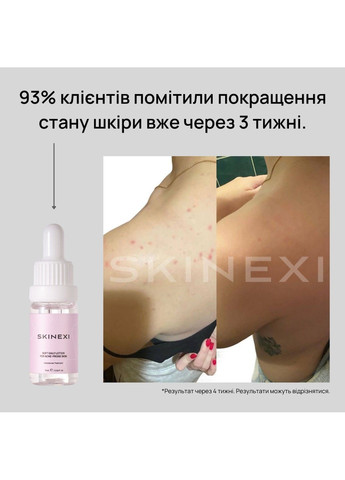Лосьон для проблемной кожи от комедонов и чёрных точек Soft Daily Lotion Skinexi (365284453)