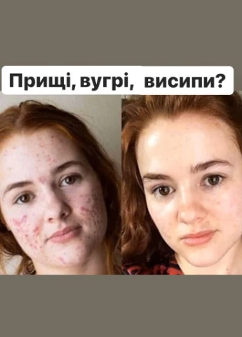 Сироватка анти-акне з рослинними екстрактами і азелаїновою кислотою J'erelia (315817870)