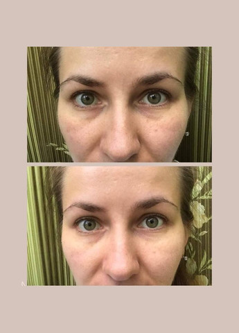 Патчі для зменшення темних кіл та набряків під очима J'erelia (315818367)